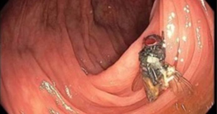 OMG! Living fly is resting in old man's Intestines