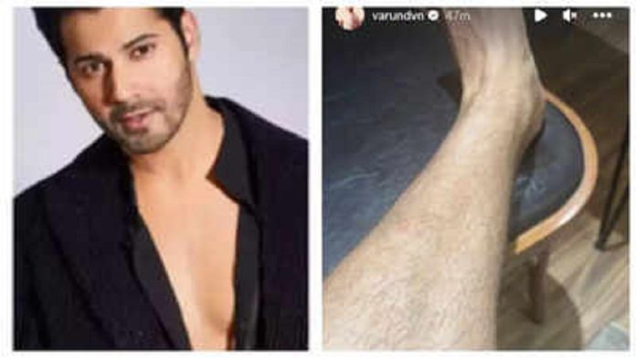 Varun Dhawan Injury